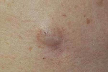 脂肪腫の原因は何ですか?