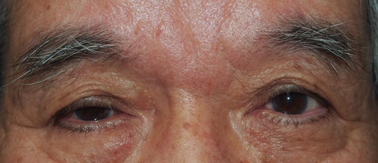 両側眼瞼下垂症（加齢性）＋右顔面神経不全麻痺