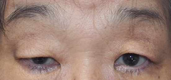 両側眼瞼下垂症（腱膜性下垂）