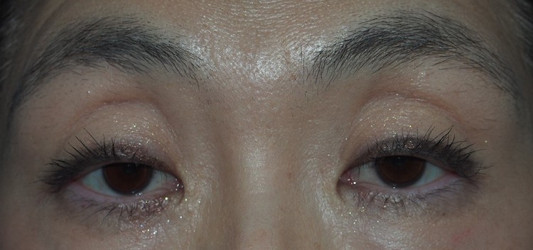 両側眼瞼下垂症（腱膜性下垂）