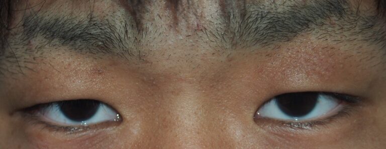 両側眼瞼下垂症（腱膜性下垂）