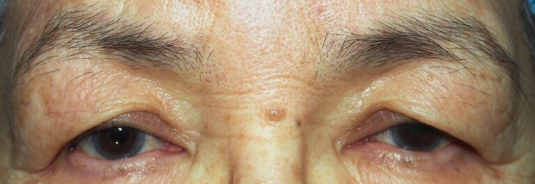両側眼瞼下垂症（腱膜性下垂）